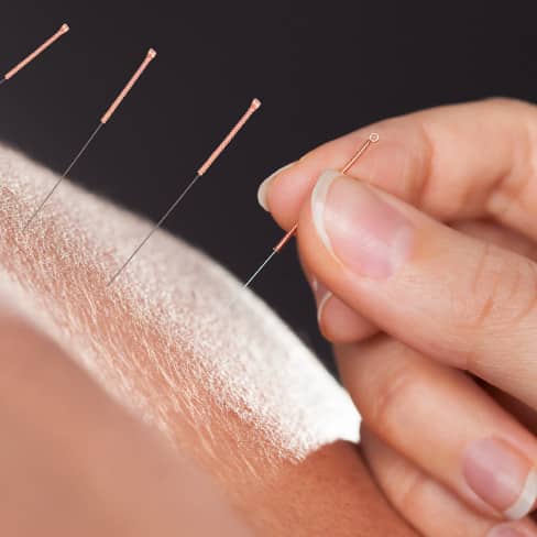 Acupuncture image
